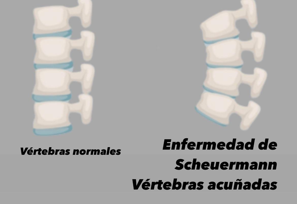 Vértebras acuñadas en la cifosis de Scheuermann