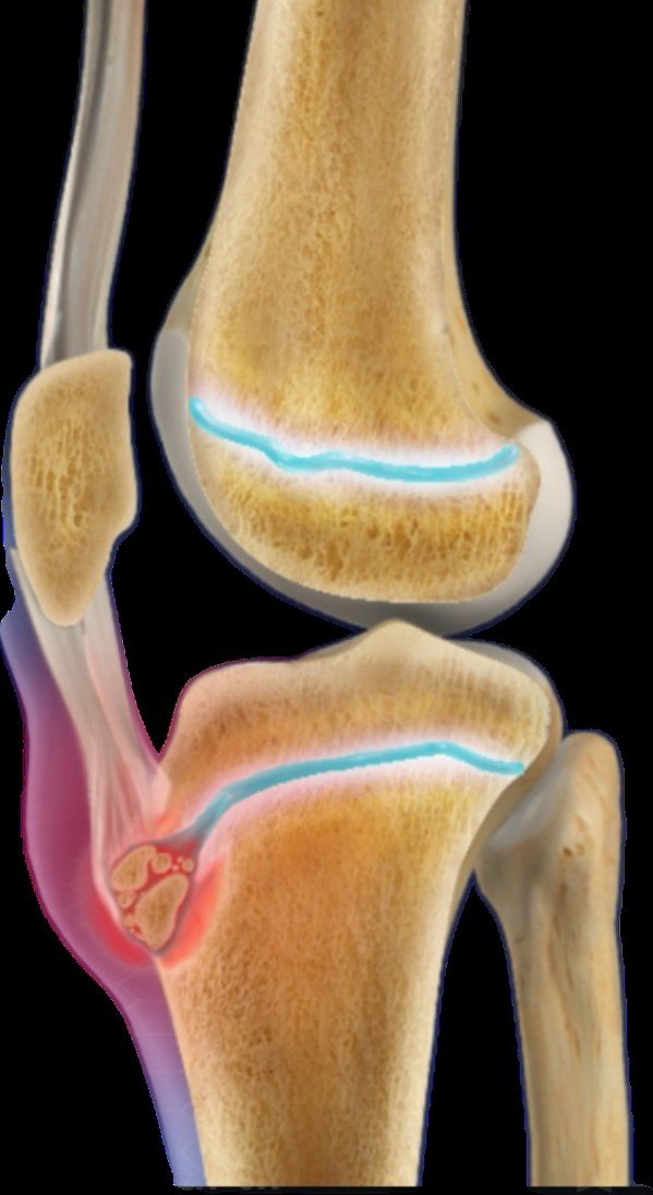 Osgood-Schlatter