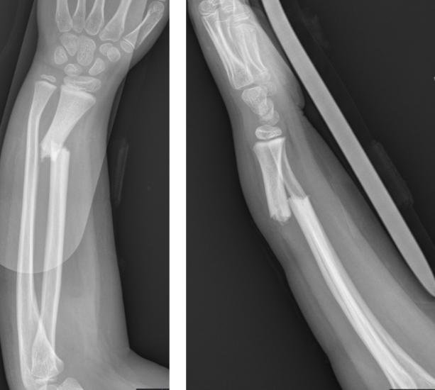 Fractura de raido y cúbito en niño Fractura de radio y cúbito en niño adolescente que requiere manejo quirúrgico