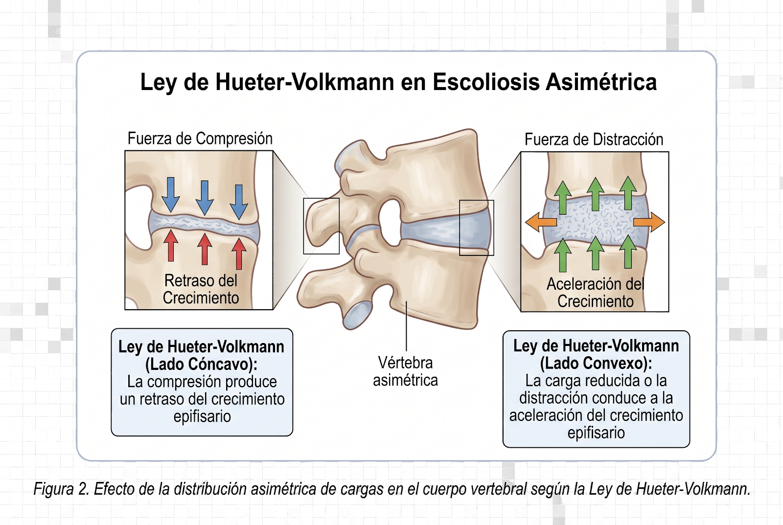 Ley de Hueter-Volkmann: la compresión frena y la descompresión estimula el crecimiento vertebral en la escoliosis